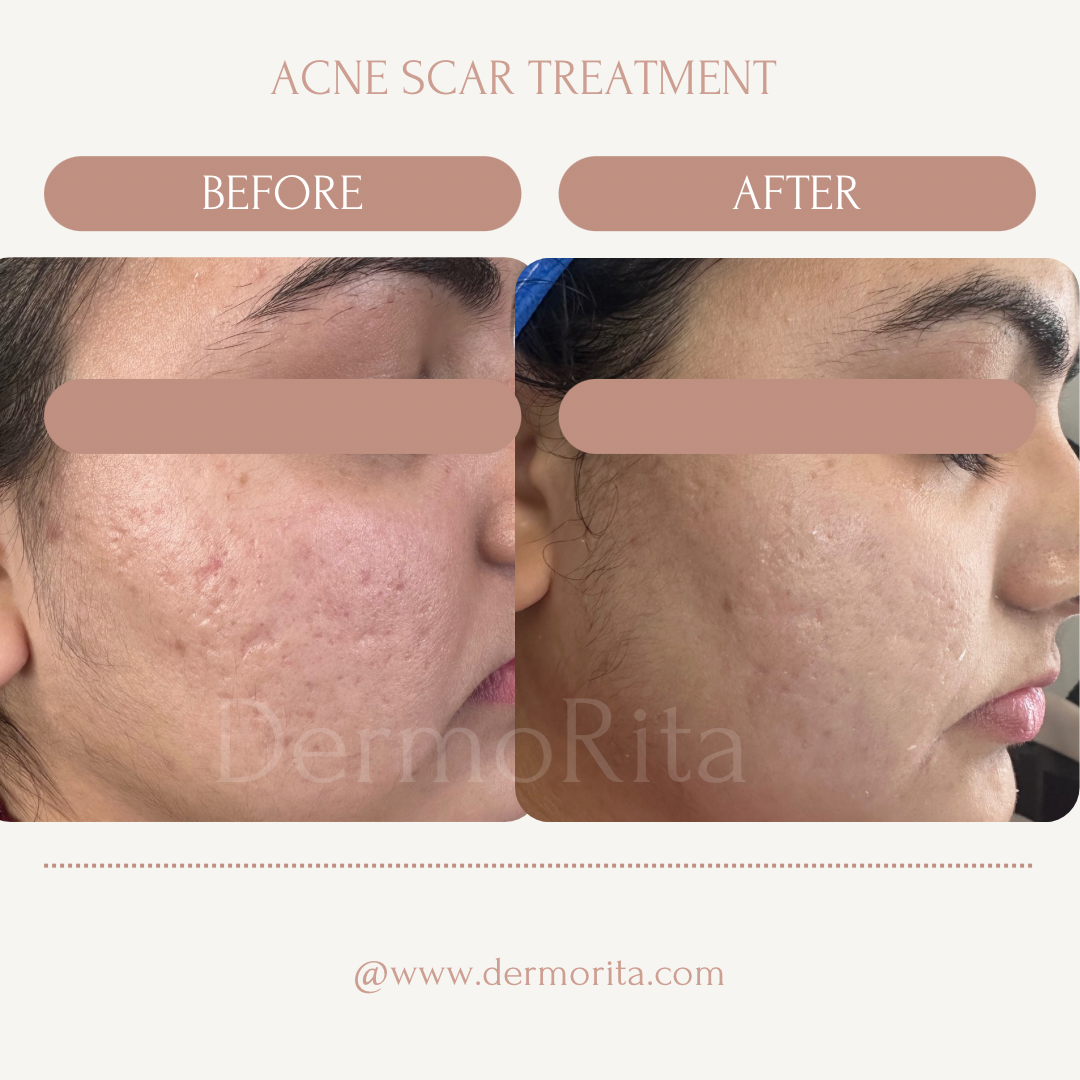 Acne scar treatment(1)