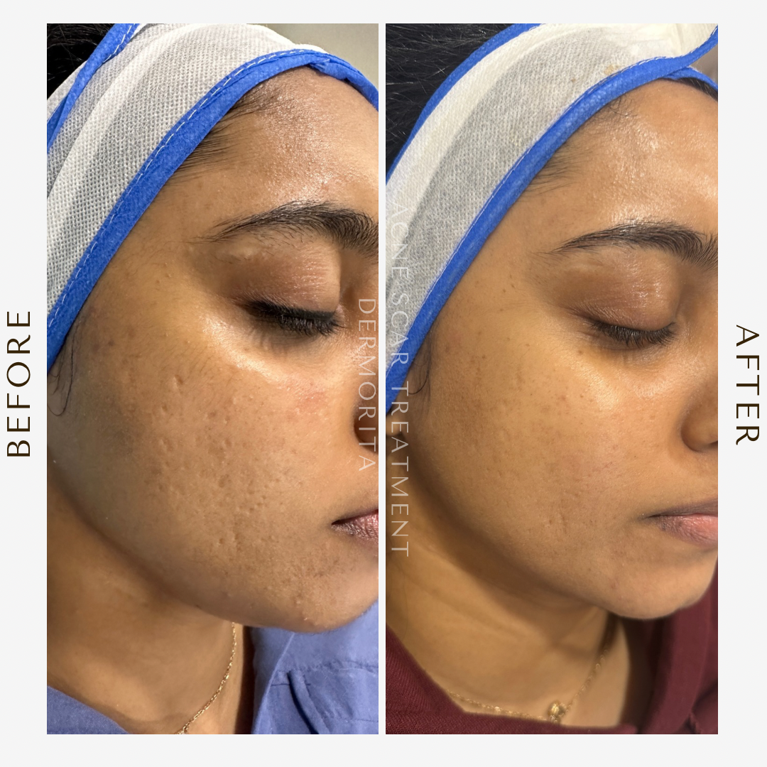 Acne scar treatment(3)