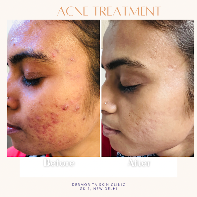 Acne treatment