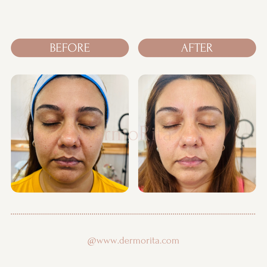 Anti aging with HIFU_