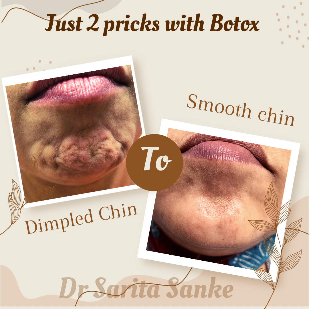 Chin botox_