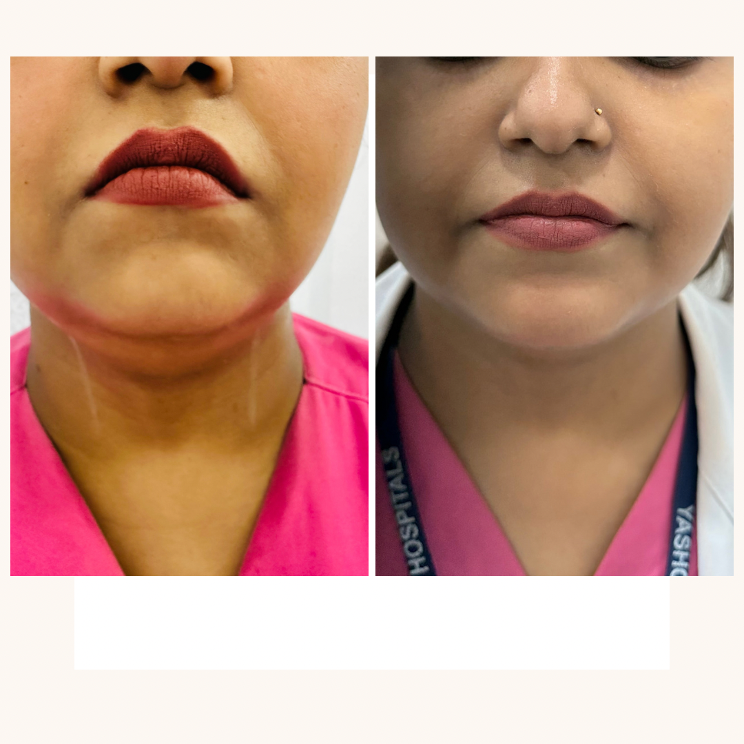 Double chin reduction_