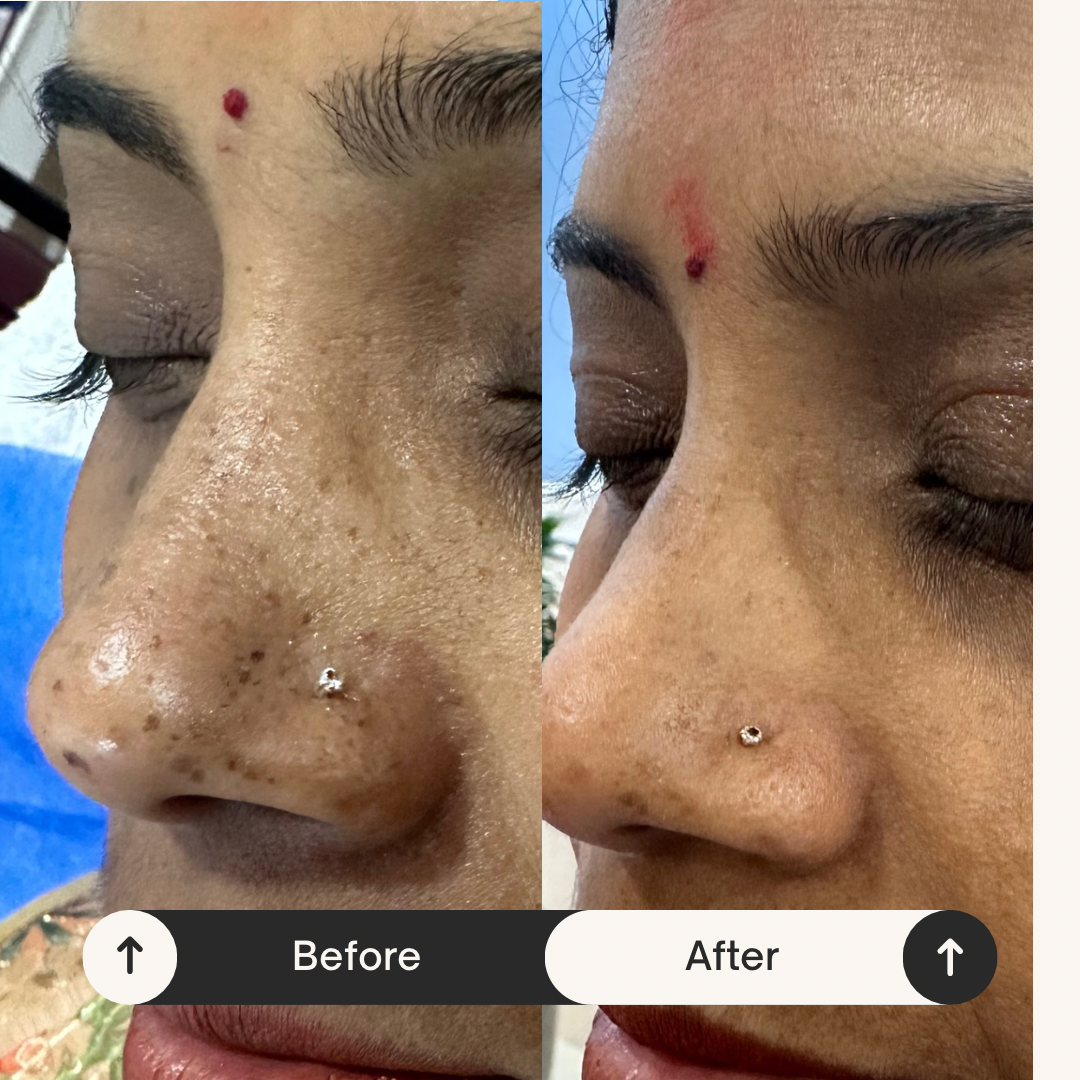 Freckles treatment