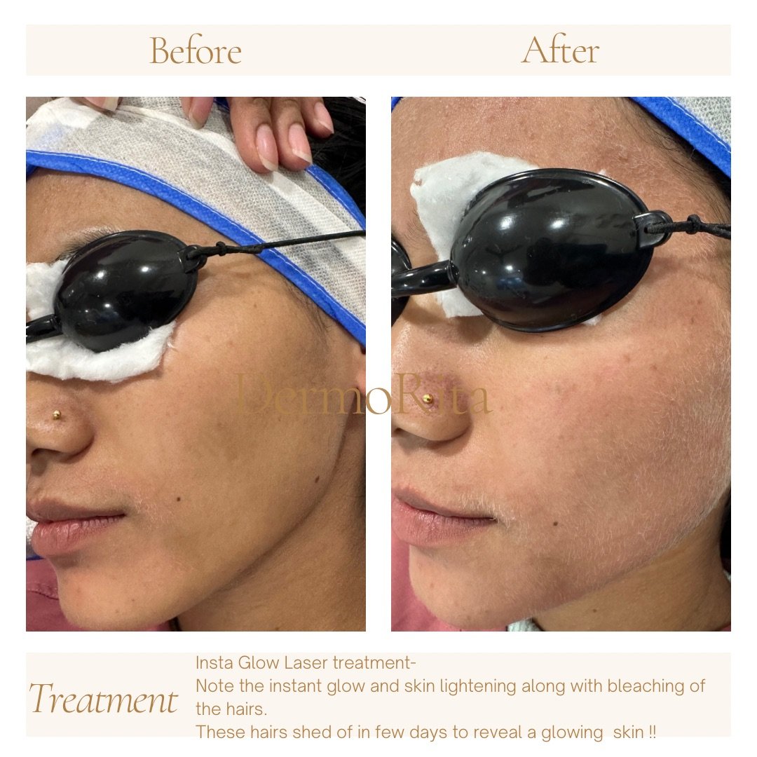 Laser toning_