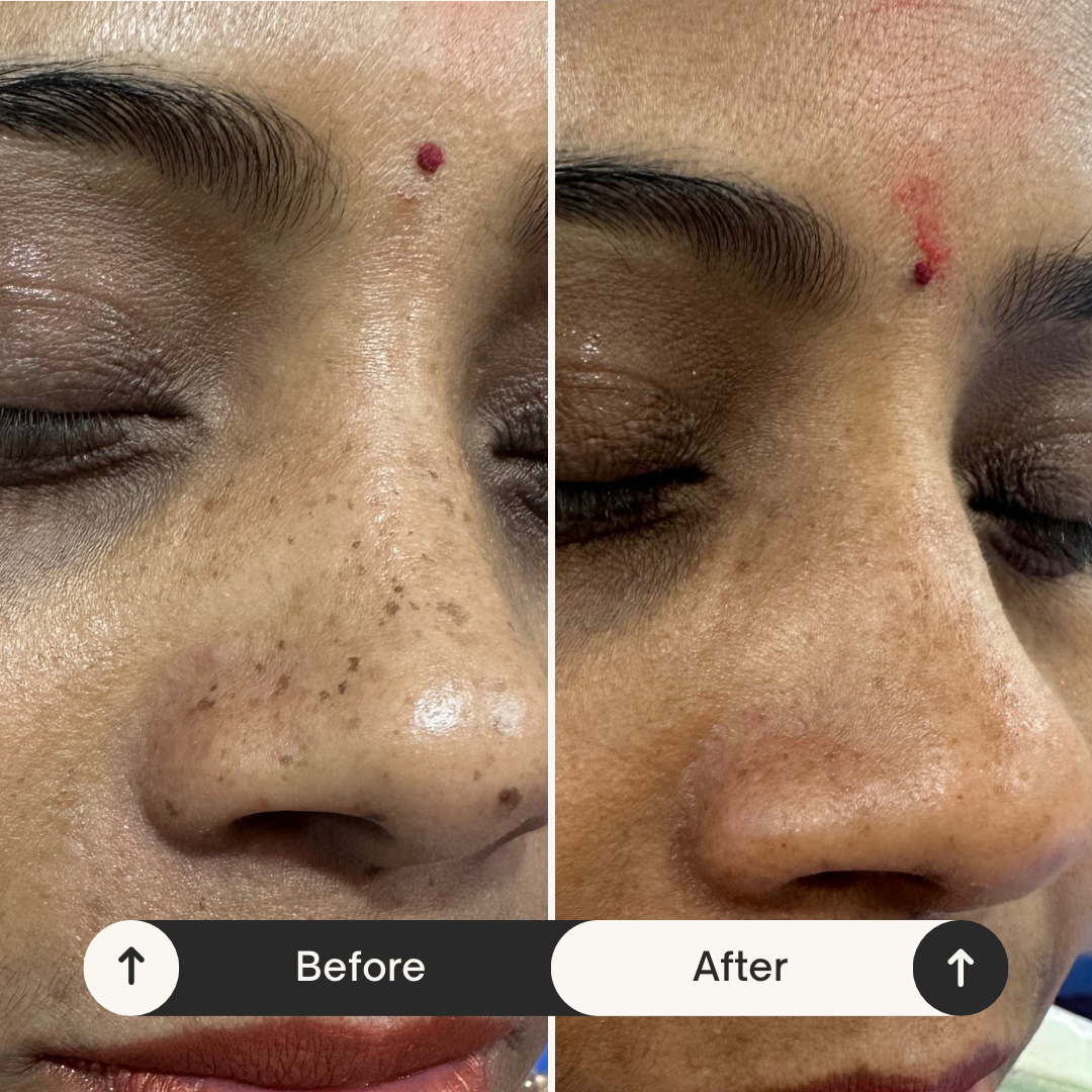 Lentigenes treatment