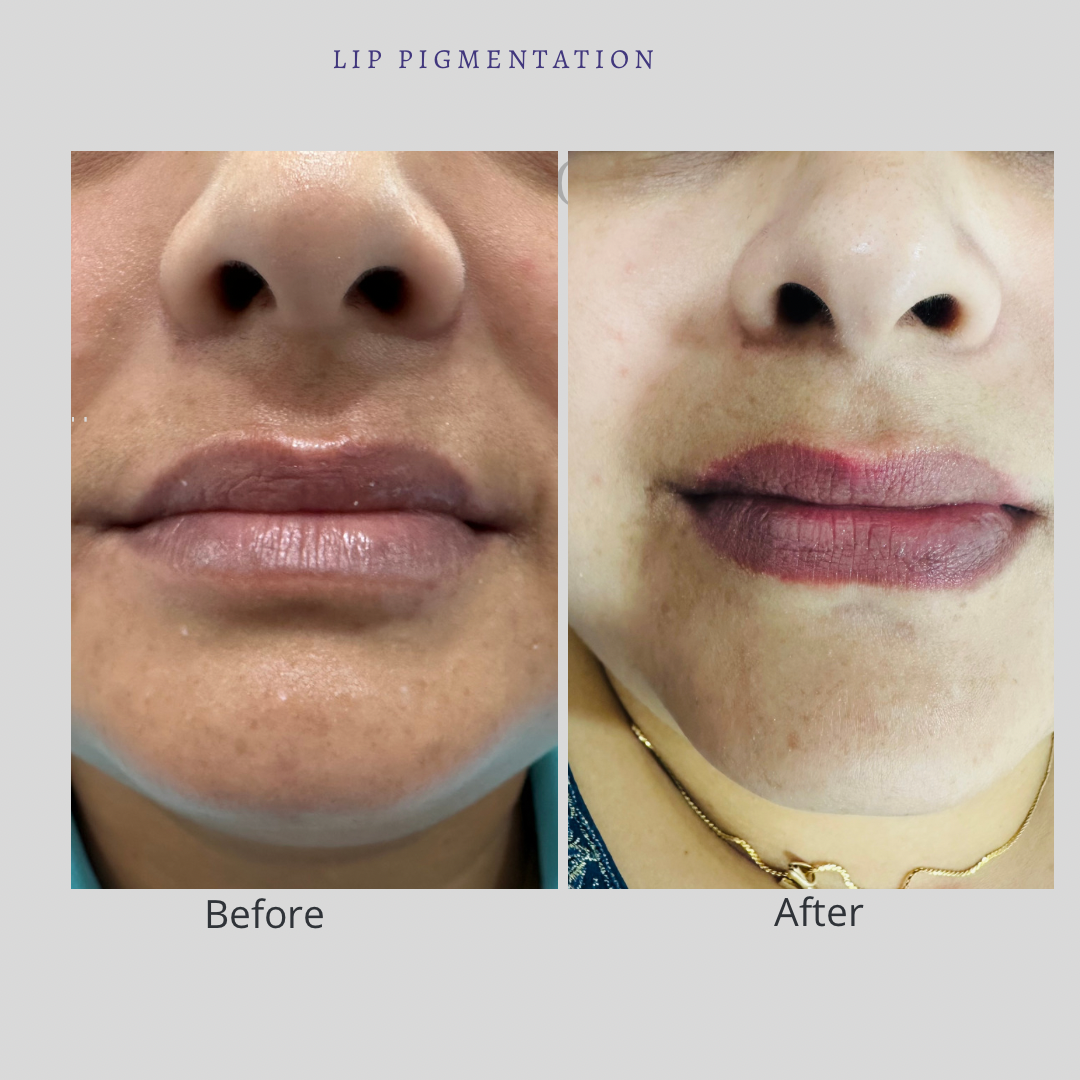 Lip pigmentation