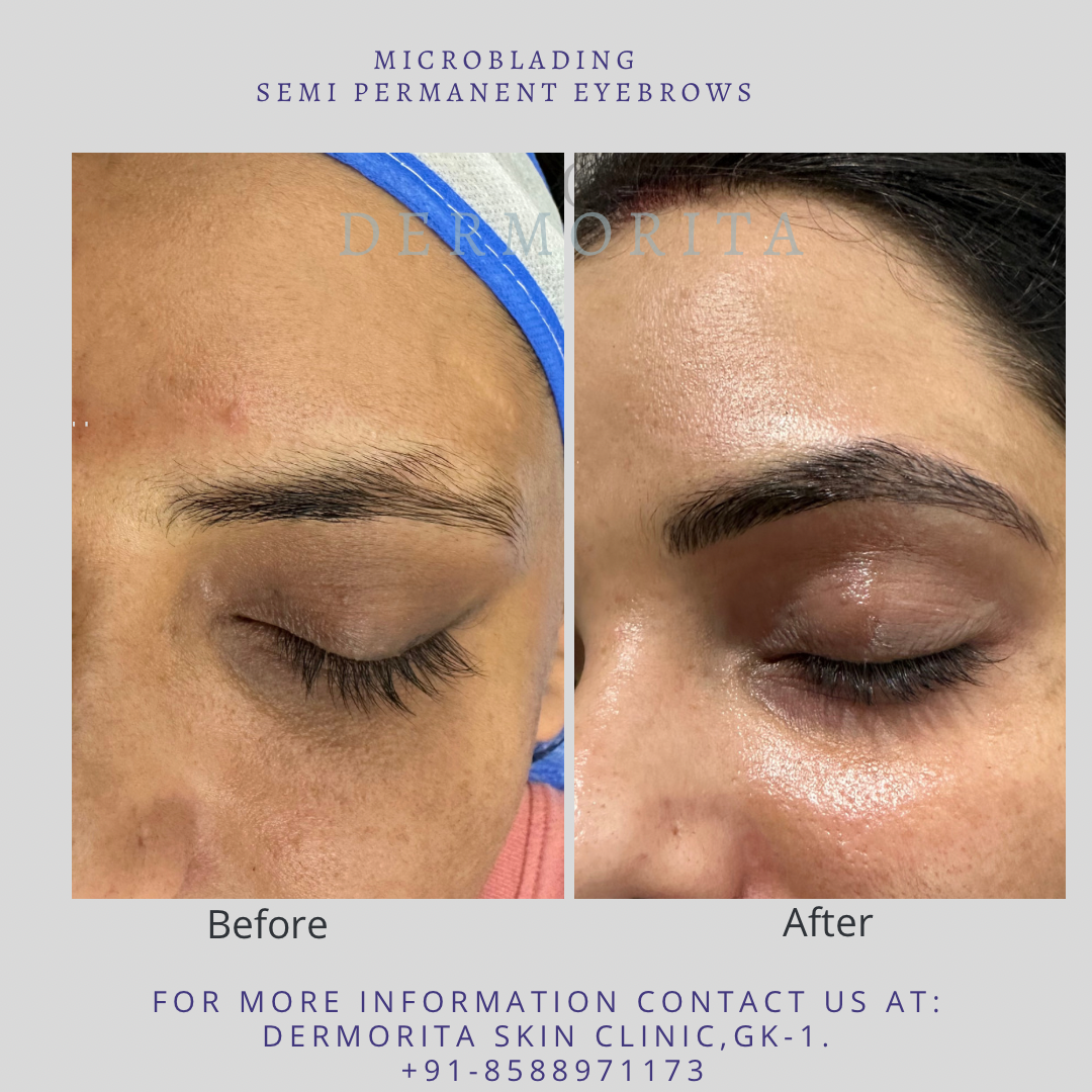 Microblading