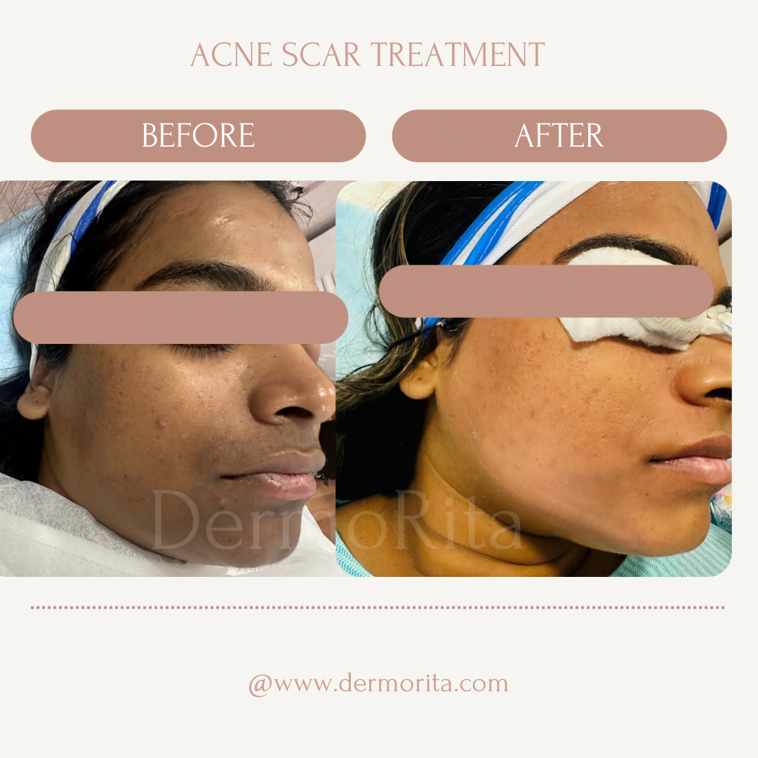 Pigmentation treatment