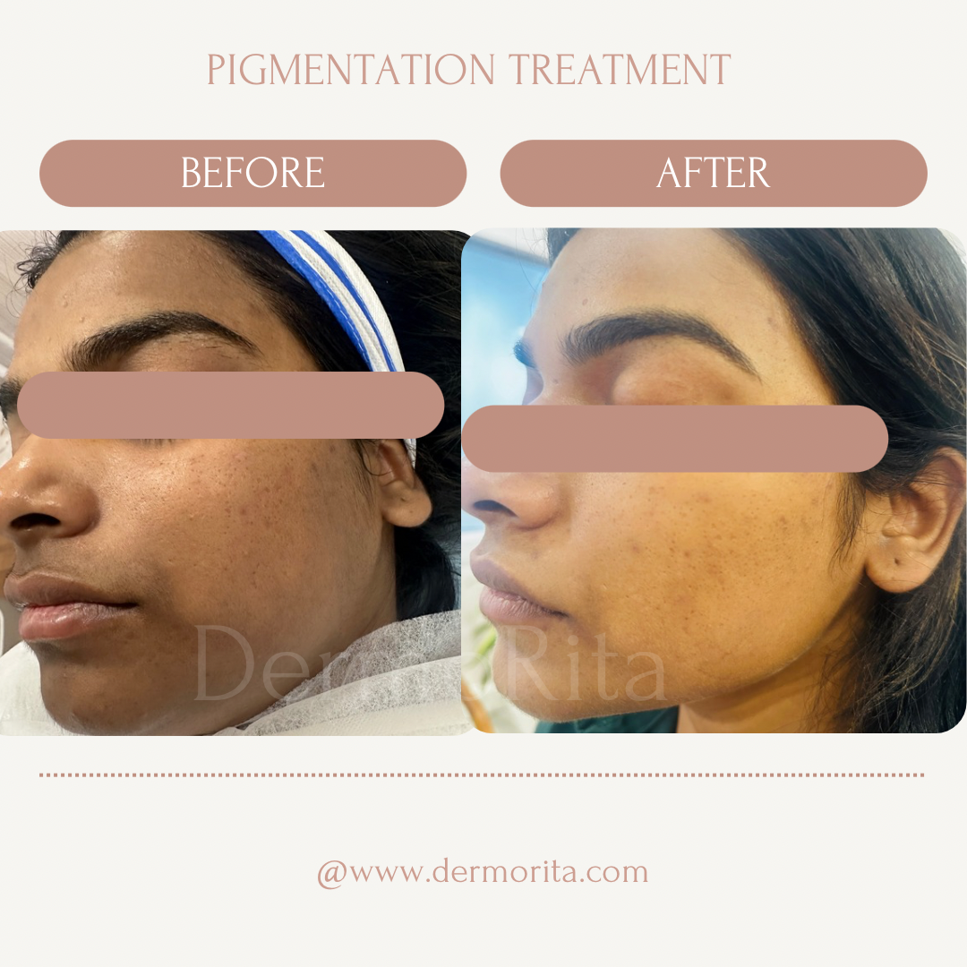 Pigmentation treatment(1)
