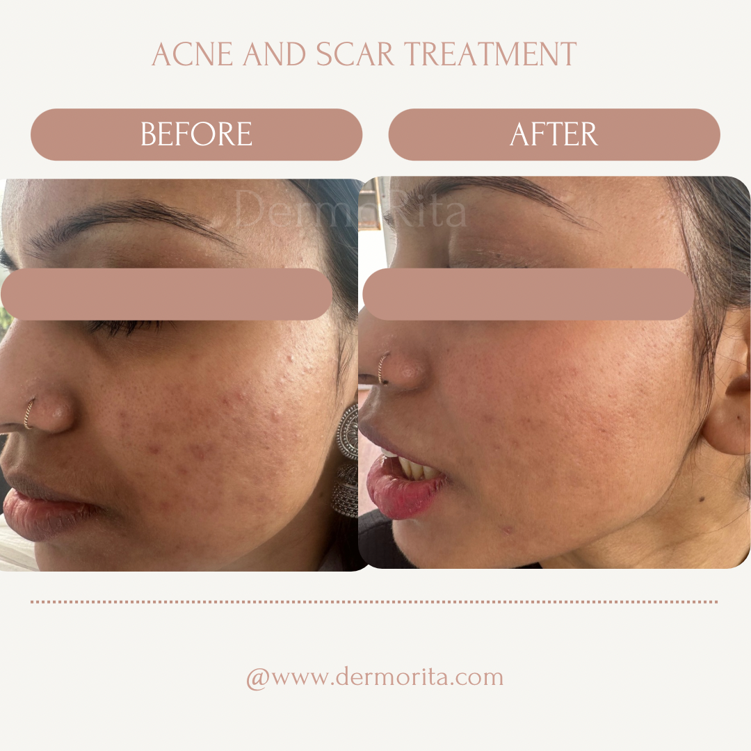 Pigmentation treatment(2)