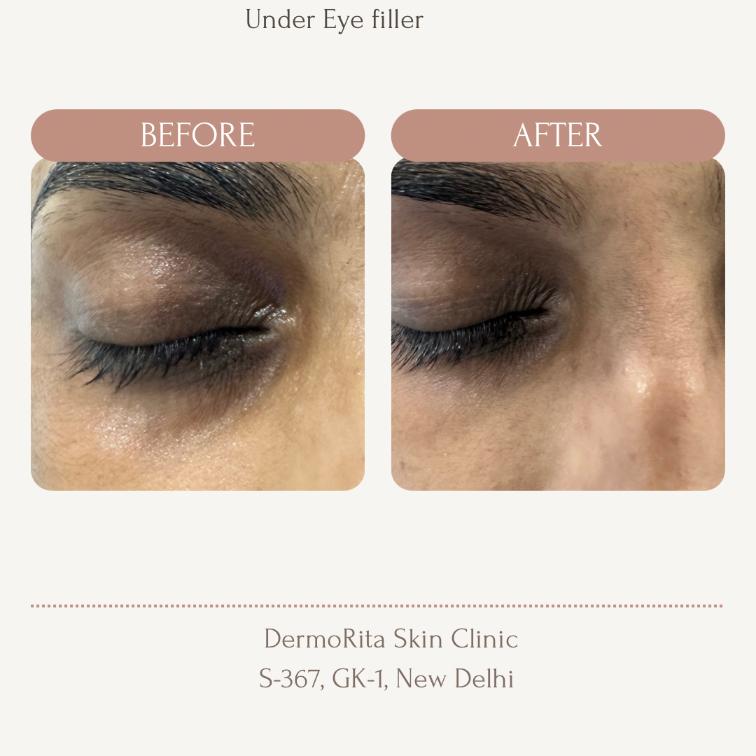 Undereye filler_
